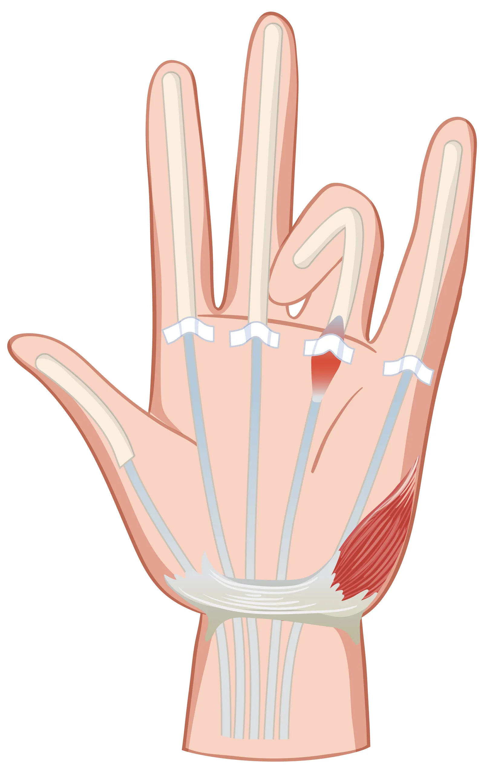 Illustration of a hand showing the area of the wrist affected by carpal tunnel syndrome